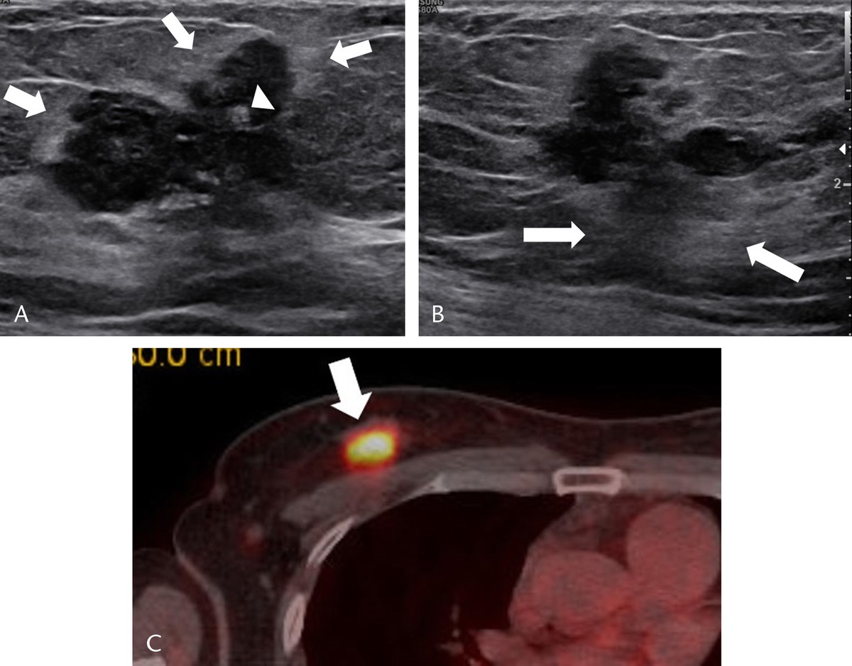 Comparison of Ultrasound Features With Maximum Standardized Uptake Value Assessed by 18F-Fluorodeoxyglucose-Positron Emission Tomography/Computed Tomography for Prognosis of Estrogen Receptor+/Human Epithelial Growth Factor Receptor 2− Breast Cancer