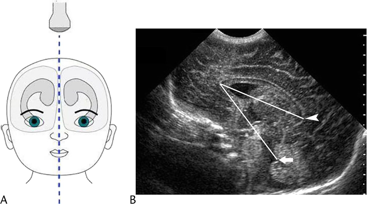 An Exploratory Study Into a New Head Ultrasound Marker for Predicting Neurodevelopmental Outcomes in Preterm Infants